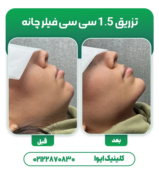 تزریق فیلر چانه