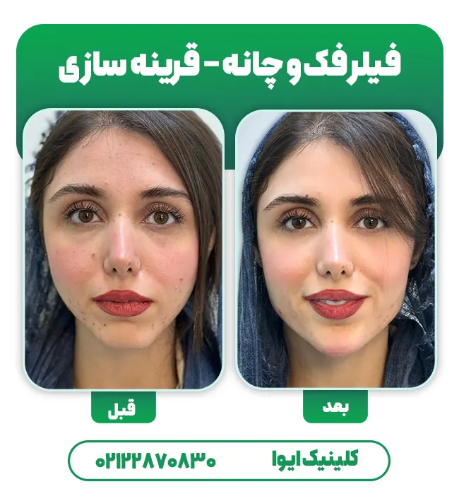 تزریق فیلر چانه