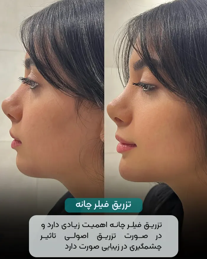 تزریق فیلر چانه