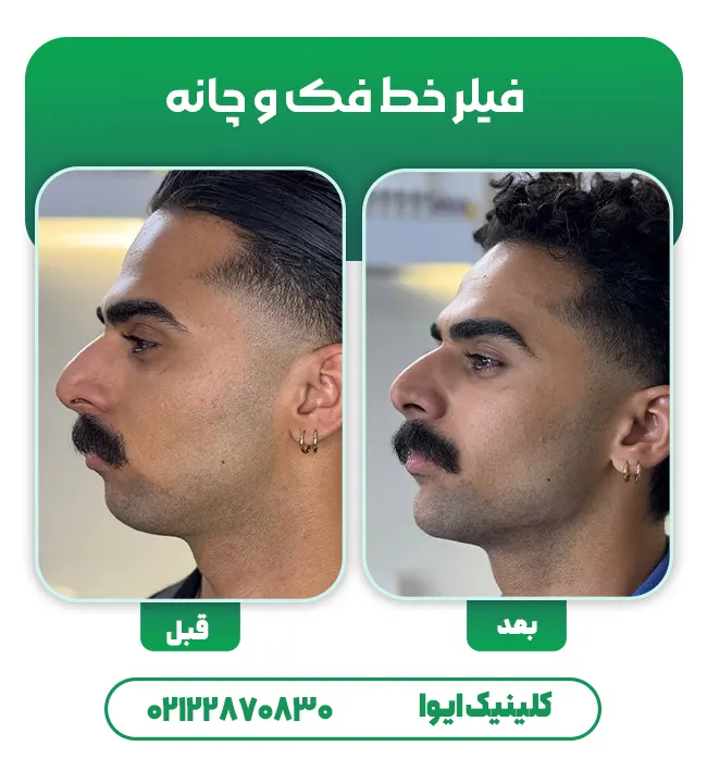 تزریق فیلر چانه مردان