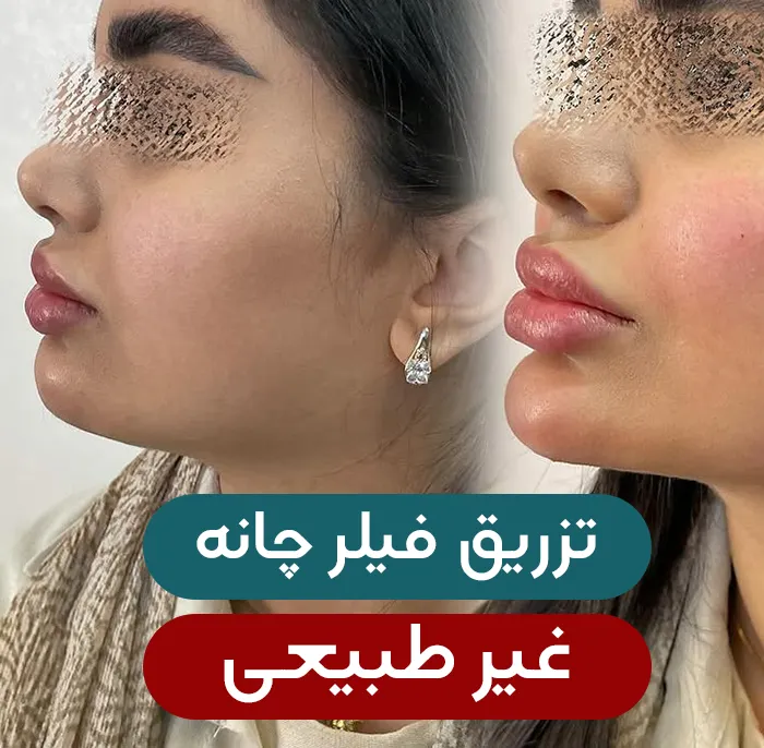 فیلر چانه غیرطبیعی