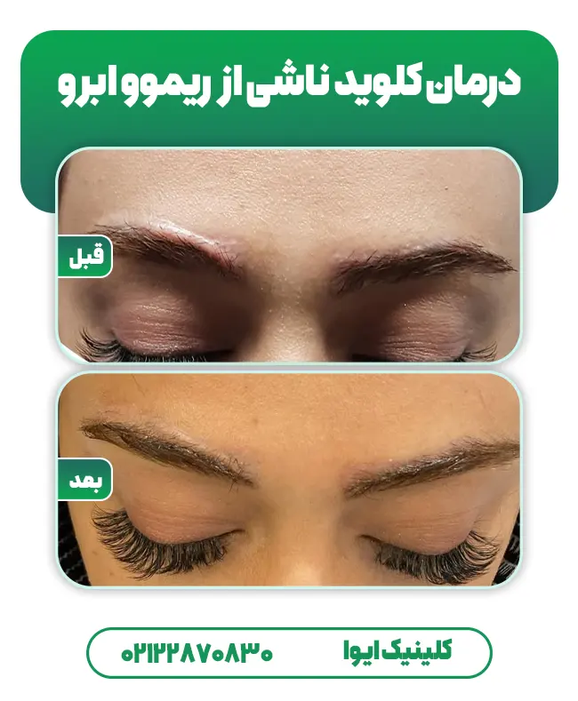 درمان کلویید ابرو