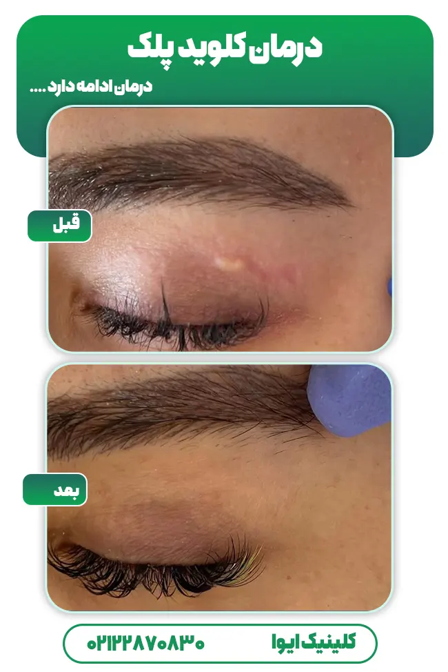 درمان کلوئید های کوچک