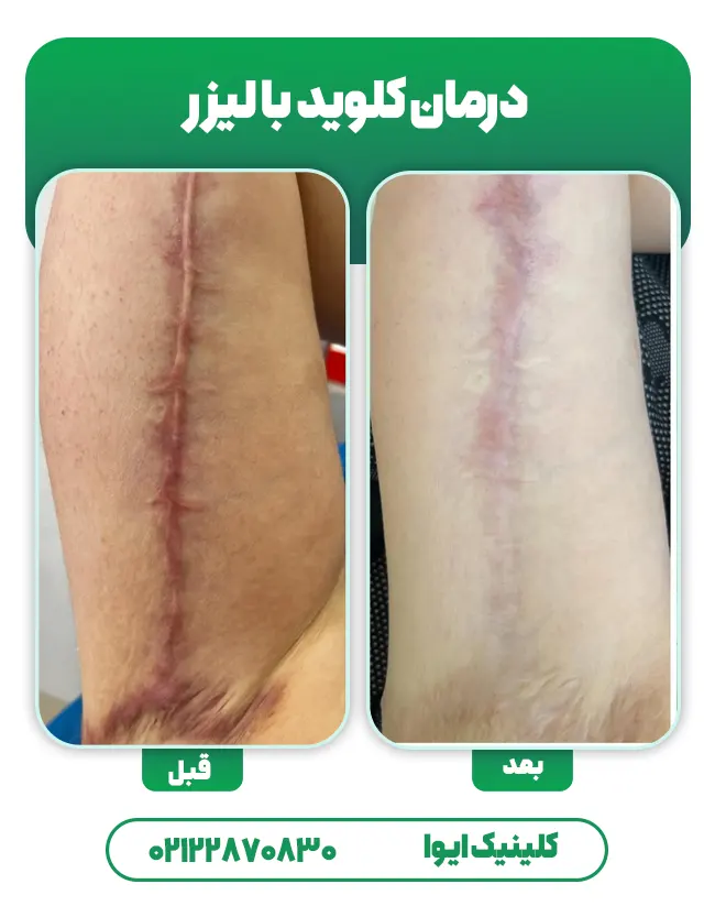 درمان کلوئید رد بخیه