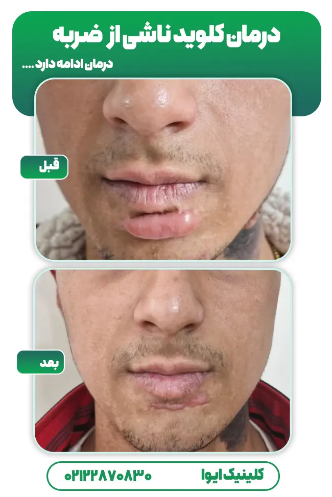 قبل بعد درمان کلوئید