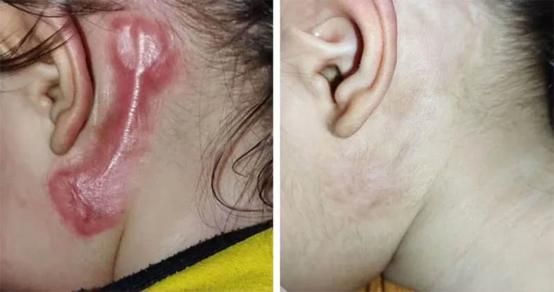 درمان کلوئید