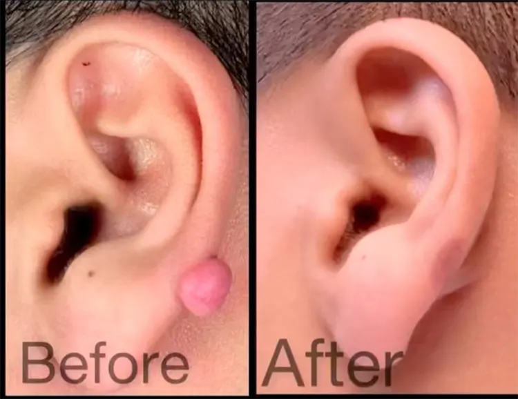 درمان کلویید لاله گوش