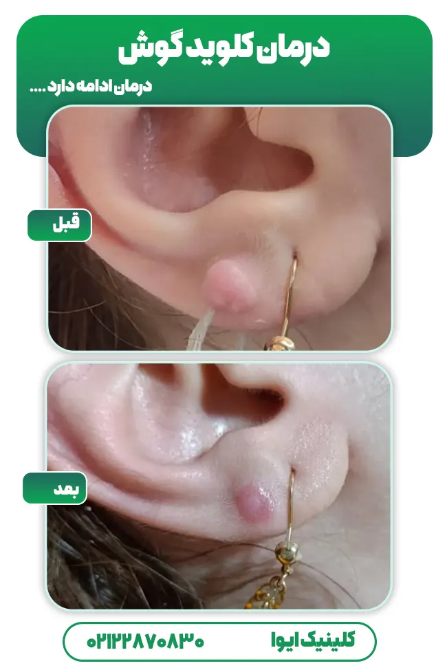 درمان کلوئید گوش