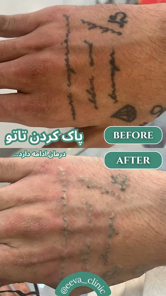 لیزر تاتو بدن