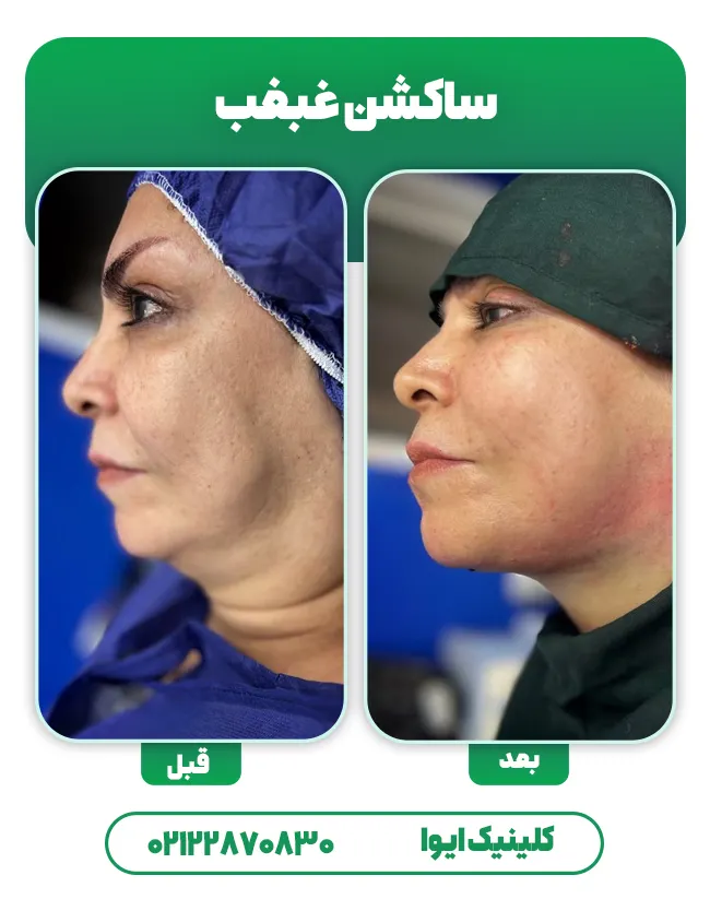 لیپو ساکشن غبغب