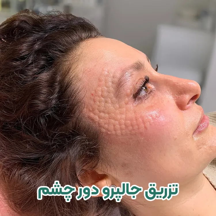 جالپرو برای دور چشم