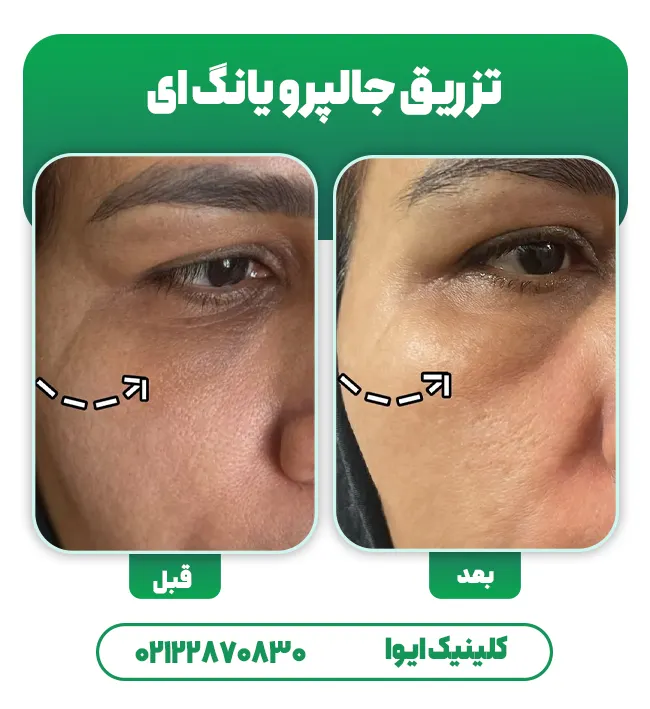 جالپرو یانگ ای