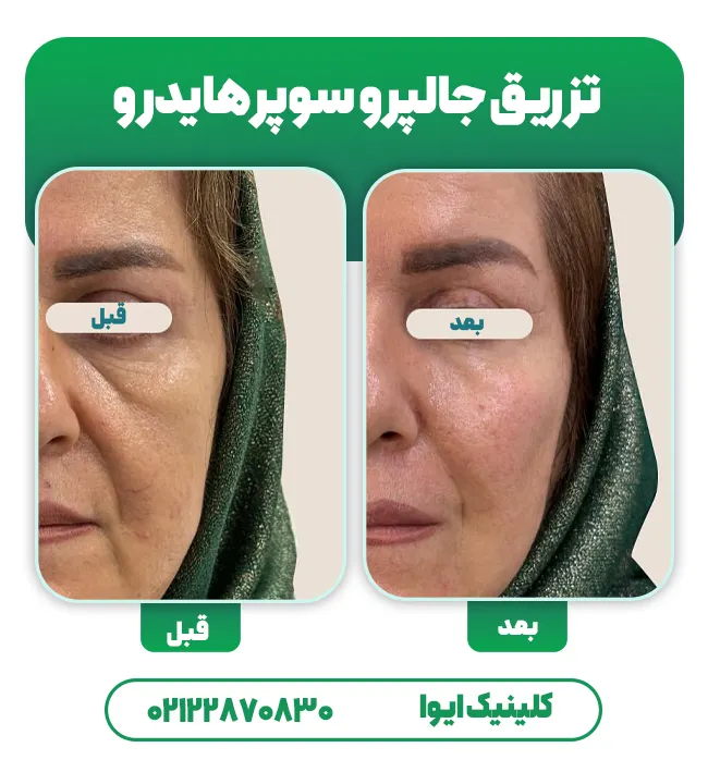 جالپرو Super Hydro