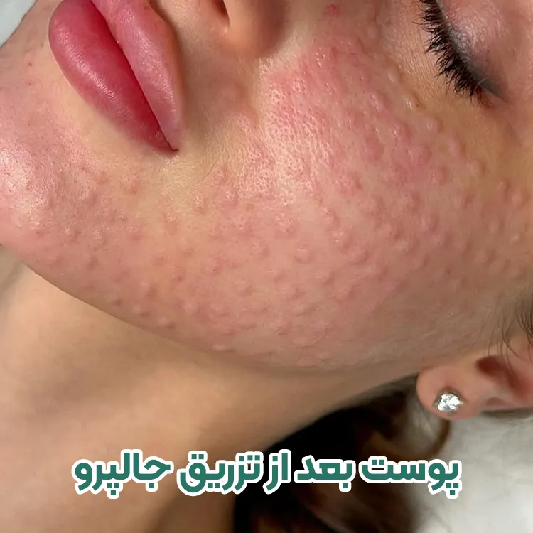 بعد از تزریق جالپرو صورت