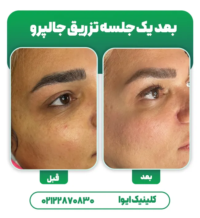 تزریق جالپرو قبل بعد