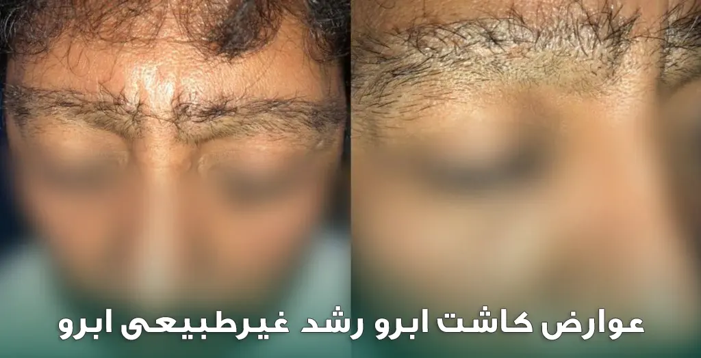 رشد غیرطبیعی ابرو