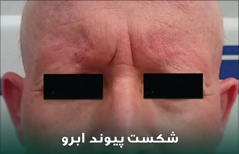 شکست پیوند مو