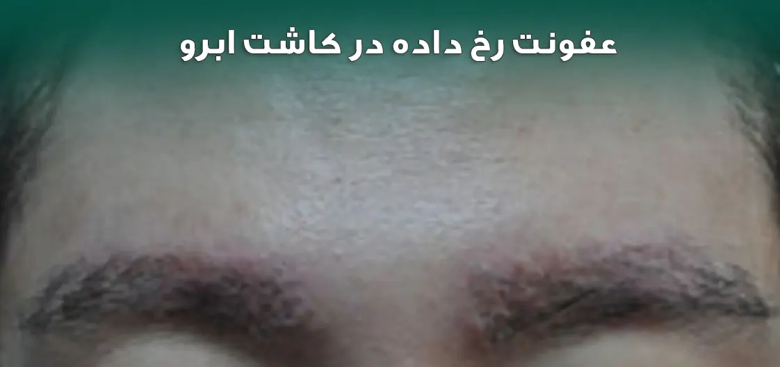 عفونت در کاشت ابرو