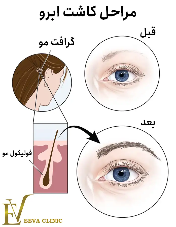 مراحل کاشت ابرو