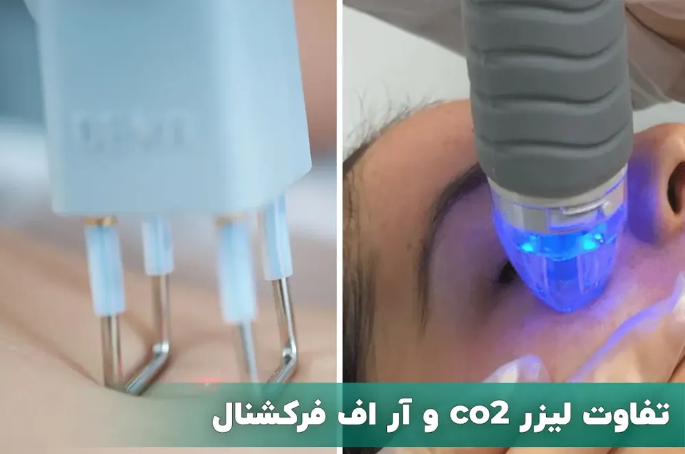 تفاوت لیزر co2 و آر اف فرکشنال
