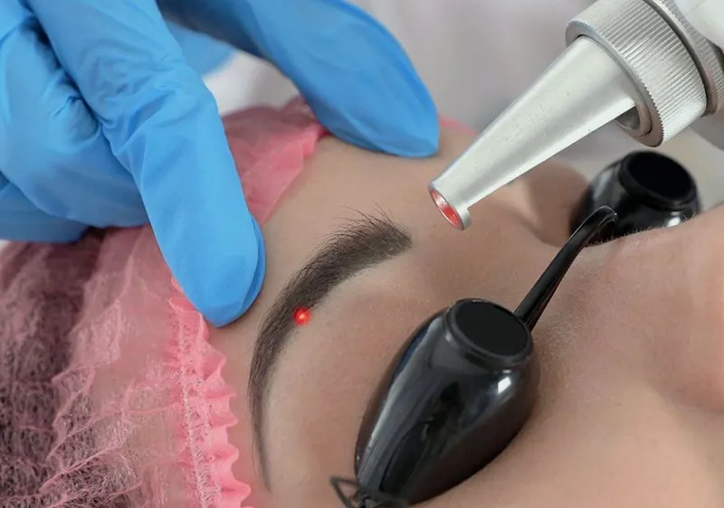 پاک کردن تاتو ابرو با لیزر کیوسوئیچ