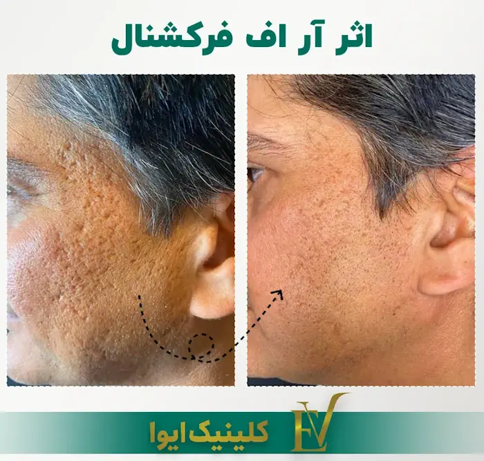 آر اف فرکشنال