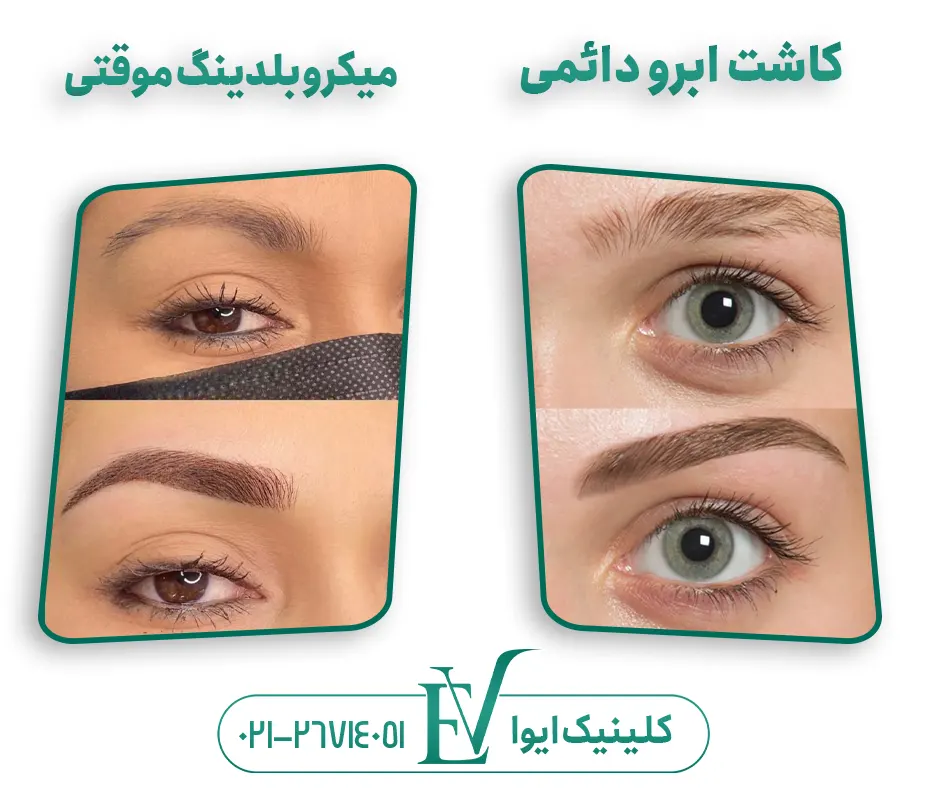 تفاوت کاشت ابرو با میکروبلدینگ
