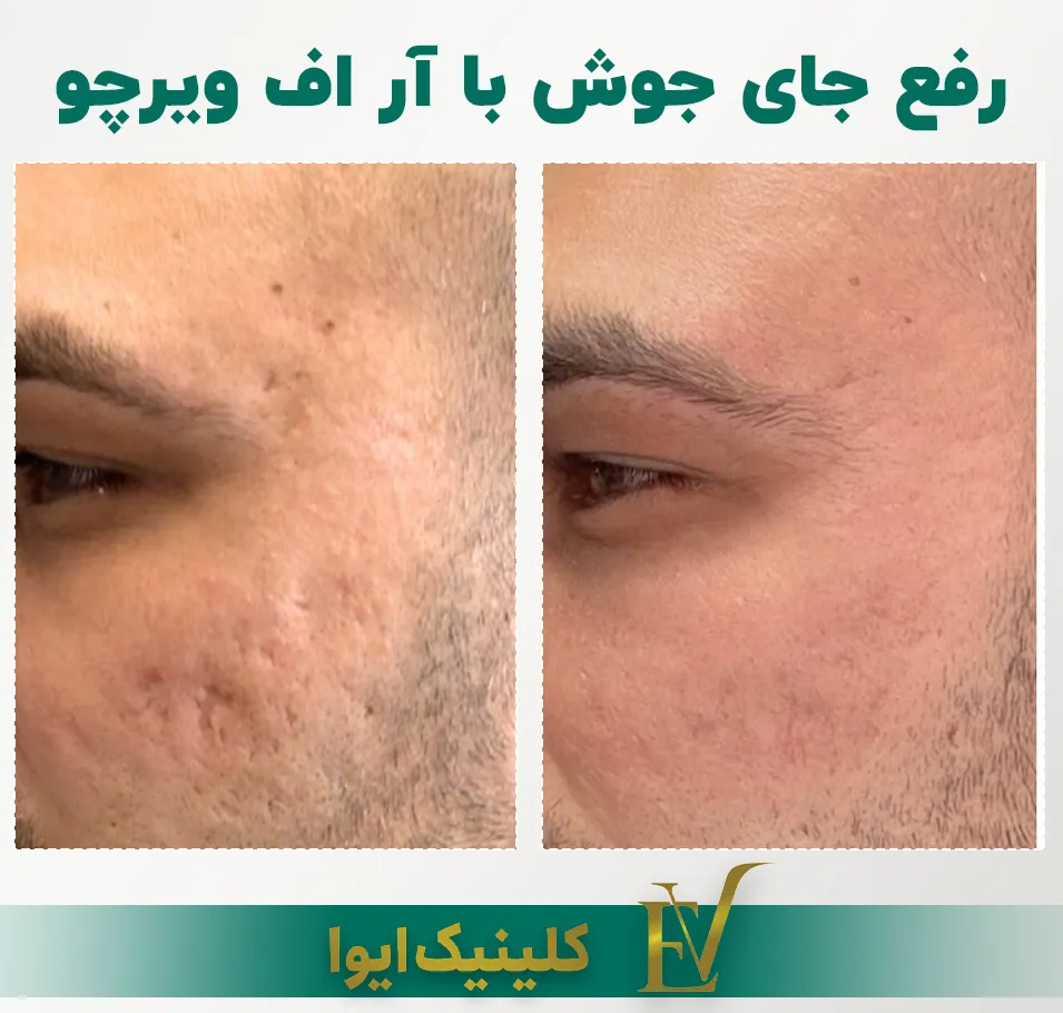 درمان جای جوش با آر اف فرکشنال ویرچو