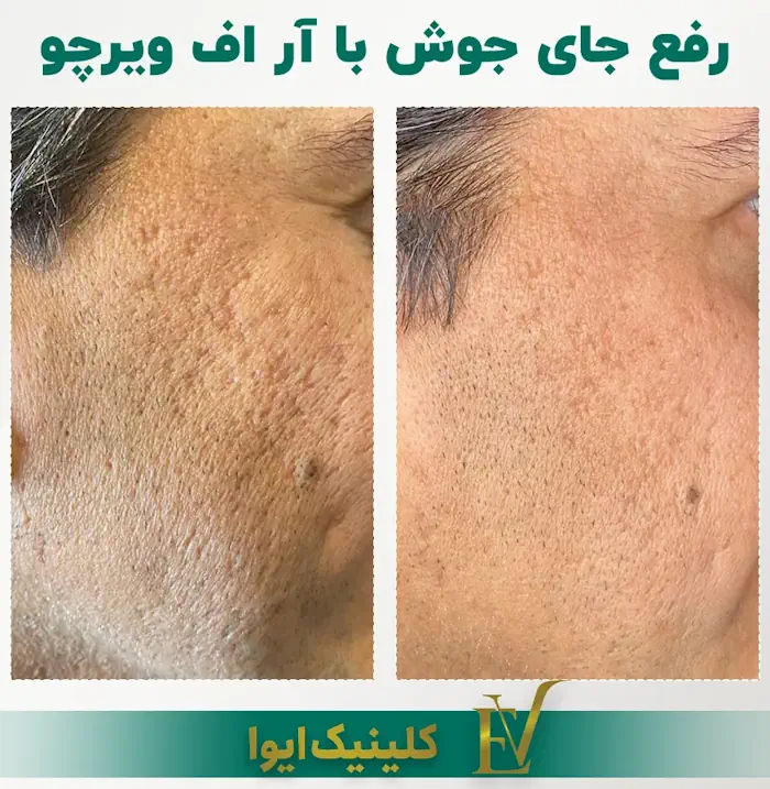 درمان جای جوش با آر اف فرکشنال ویرچو