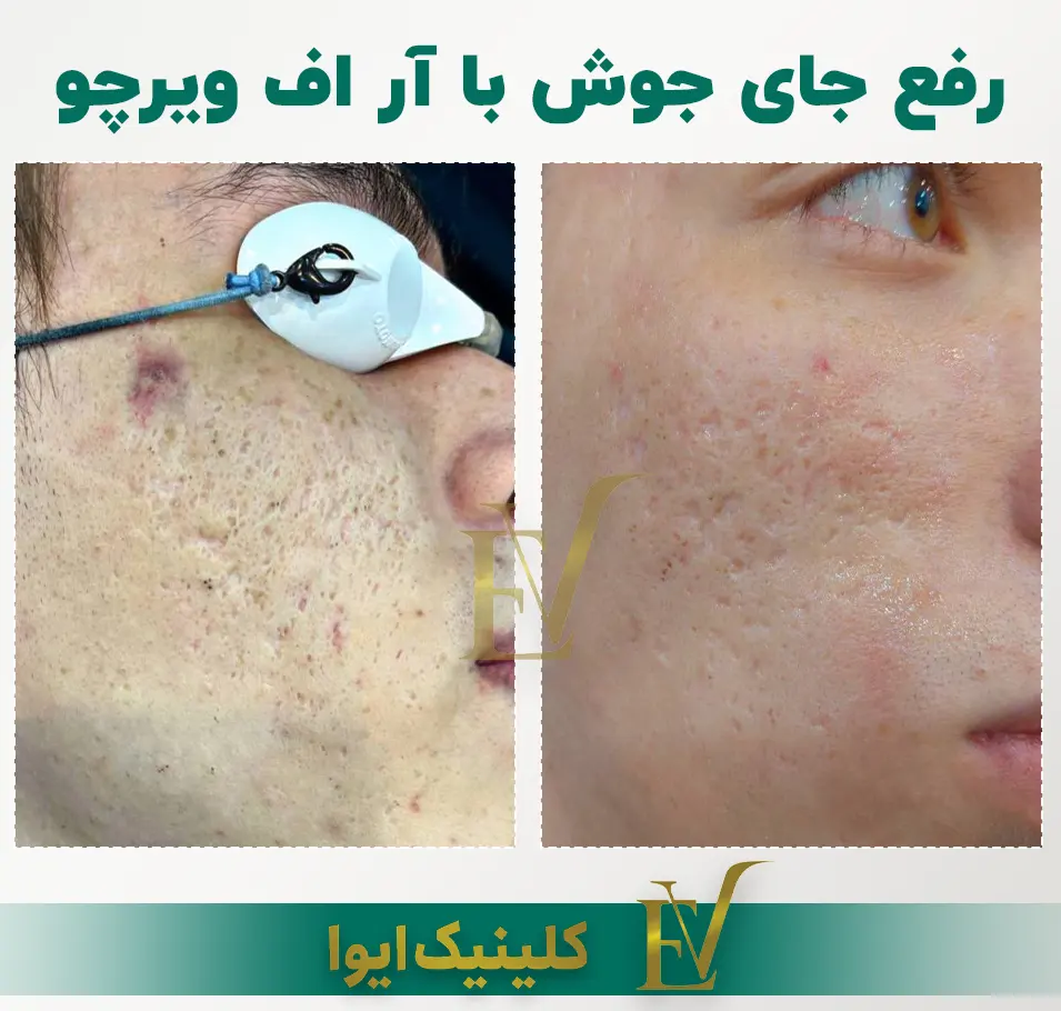 درمان جای جوش با آر اف فرکشنال