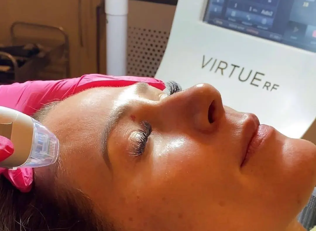 درمان جای جوش با آر اف فرکشنال ویرچو