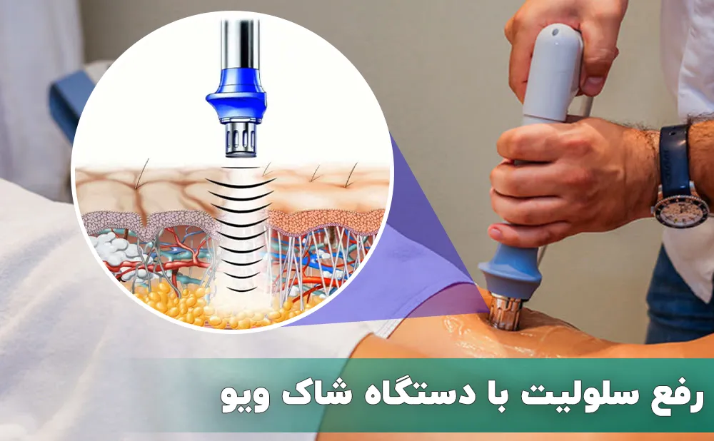 رفع سلولیت با شاک ویو