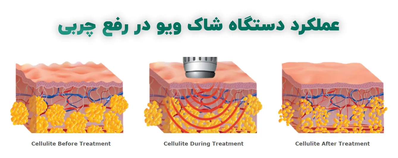 عملکرد دستگاه شاک ویو