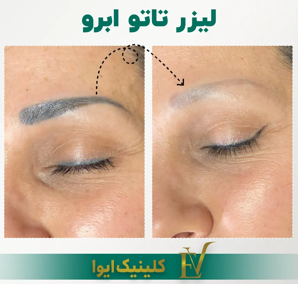 پاک کردن تاتو ابرو با لیزر