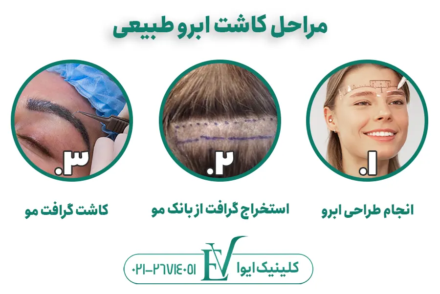 مراحل کاشت ابرو طبیعی