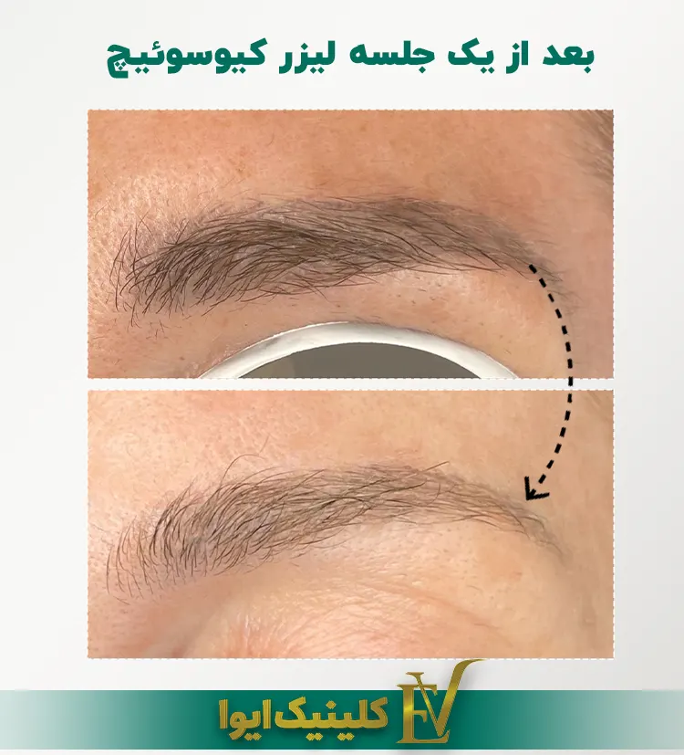 پاک کردن تاتو ابرو با لیزر