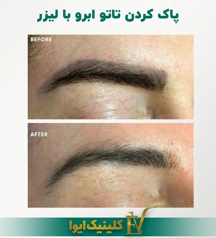 پاک کردن تاتو ابرو با لیزر