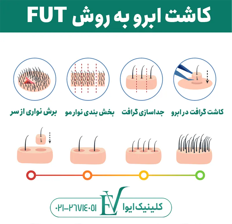 کاشت نواری یا FUT