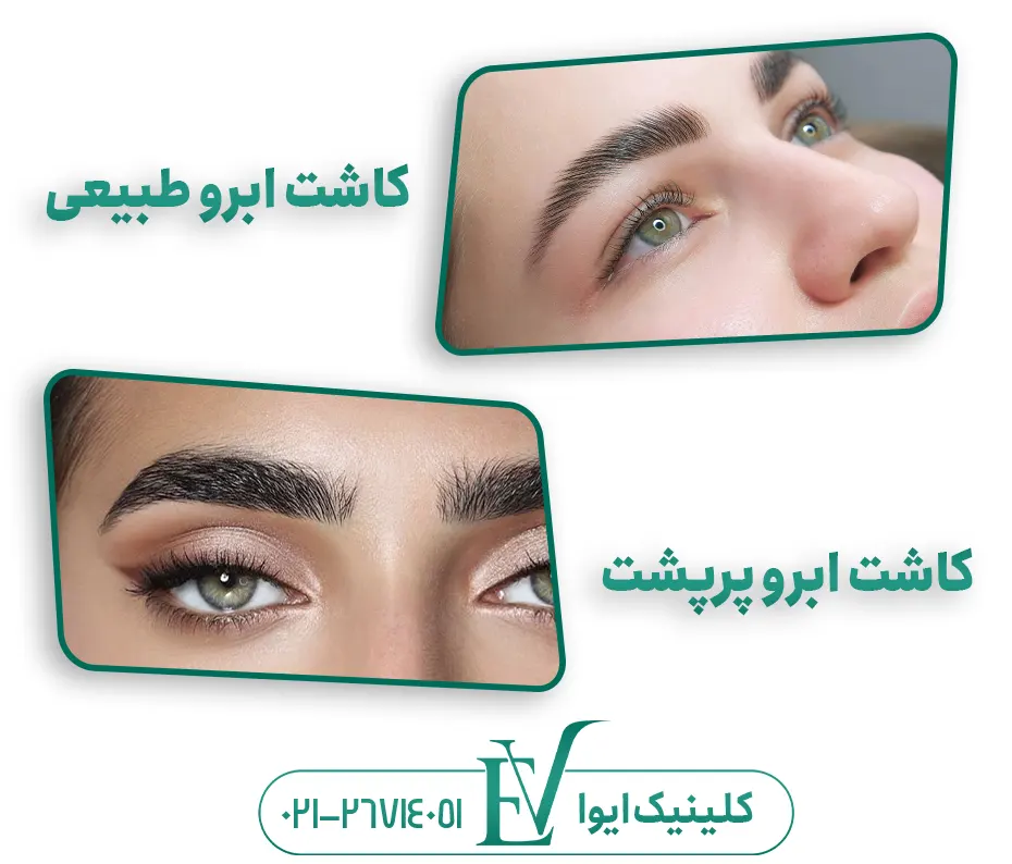 کاشت ابرو طبیعی