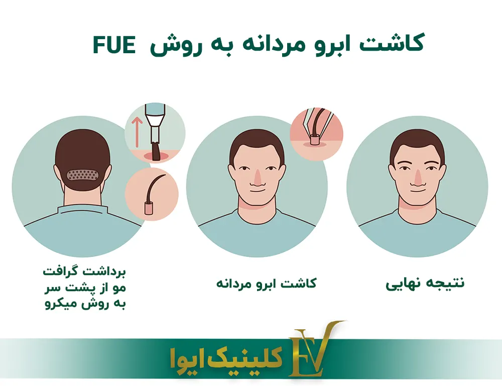 کاشت ابرو به روش FUE