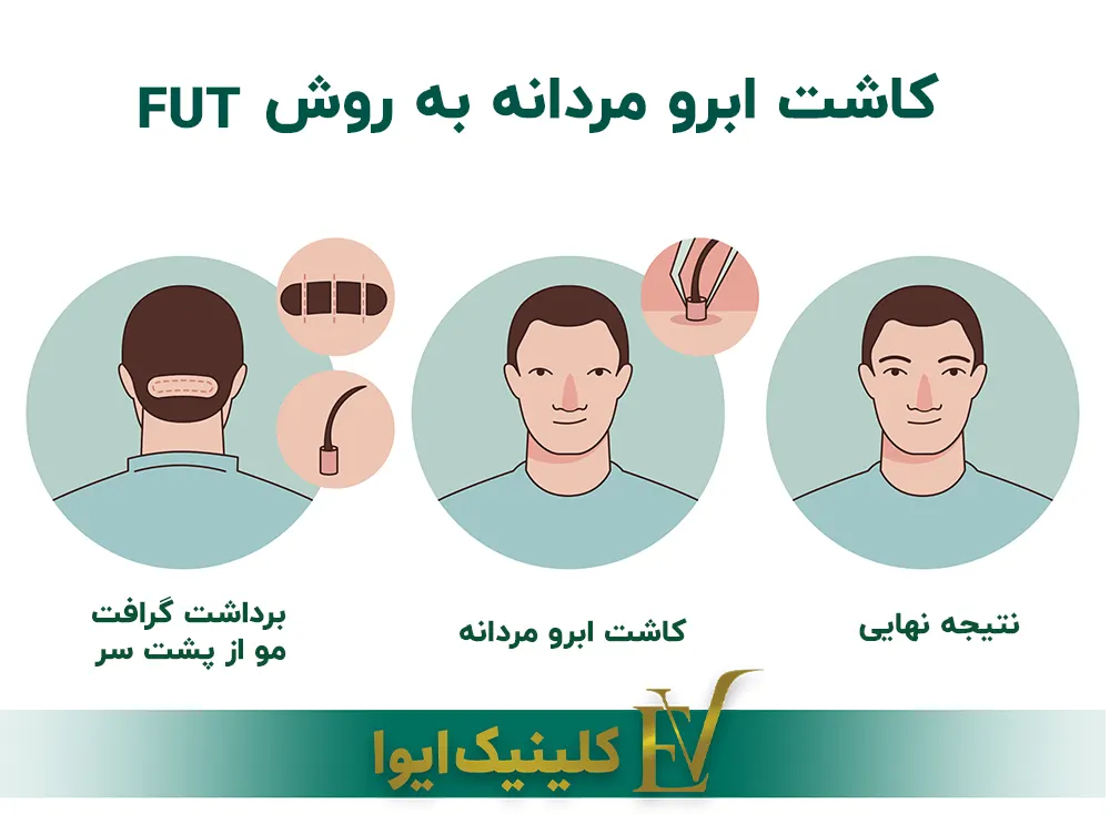 کاشت ابرو به روش FUT
