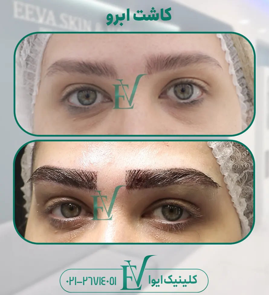 کاشت ابرو کلینیک ایوا-14