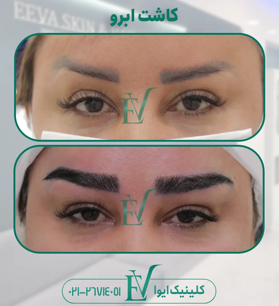 کاشت ابرو کلینیک ایوا