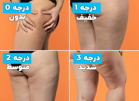 شدت عارضه سلولیت
