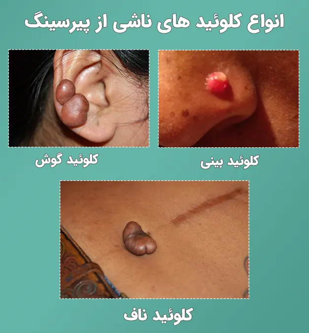کلوئید ناشی از پیرسینگ