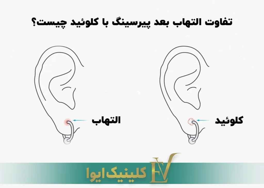 تفاوت التهاب بعد پیرسینگ با کلوئید چیست؟