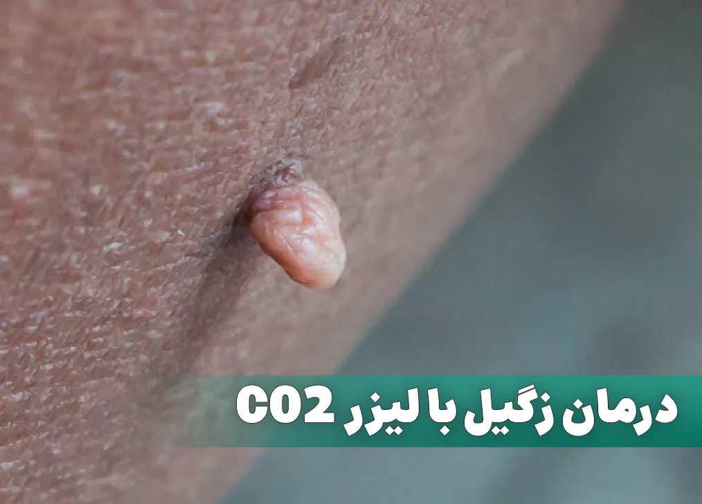 درمان زگیل با لیزر