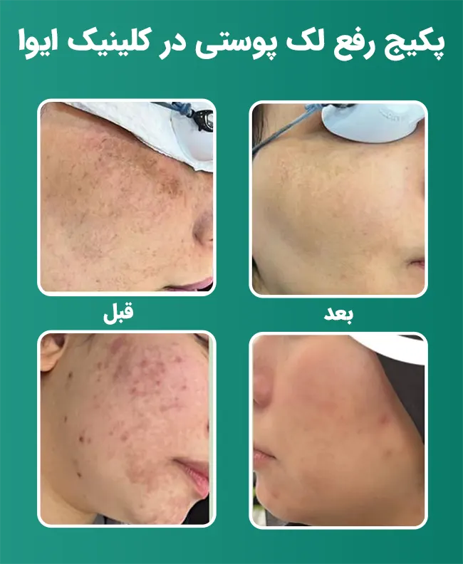 از بین بردن لک قهوه ای پوست