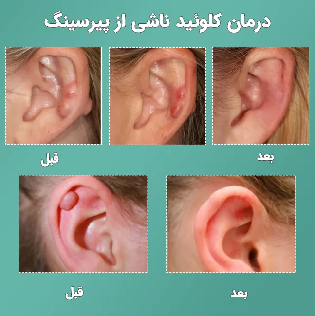 درمان کلوئید ناشی از پیرسینگ