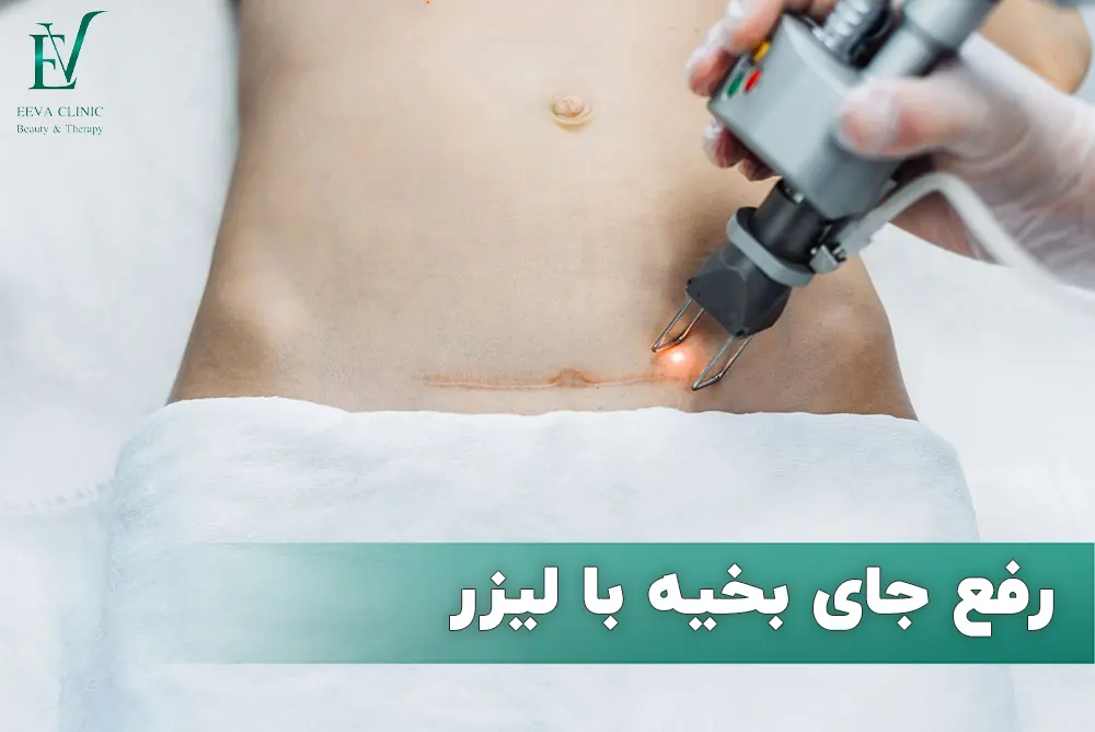 رفع جای بخیه با لیزر
